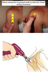 Vascular Access Procedures - Humeral Head Insertion